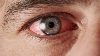 Eğer gözünüz bu hale gelirse...