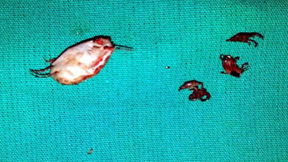 84 yaşındaki çiftçinin kulağından 7 kene çıkarıldı