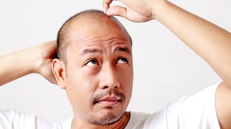 Kelliğe karşı saç klonlama