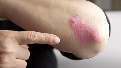 Sedef deyip geçmeyin! Başka hastalıklara davetiye çıkarıyor!