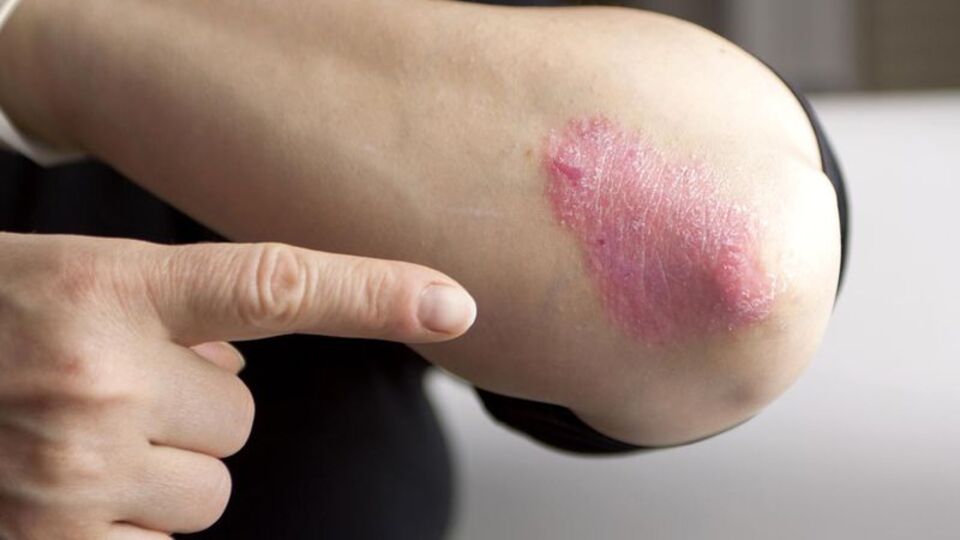 Sedef deyip geçmeyin! Başka hastalıklara davetiye çıkarıyor!