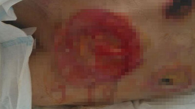 Korkunç! Hastanede 66 günde sırtı bu hale geldi