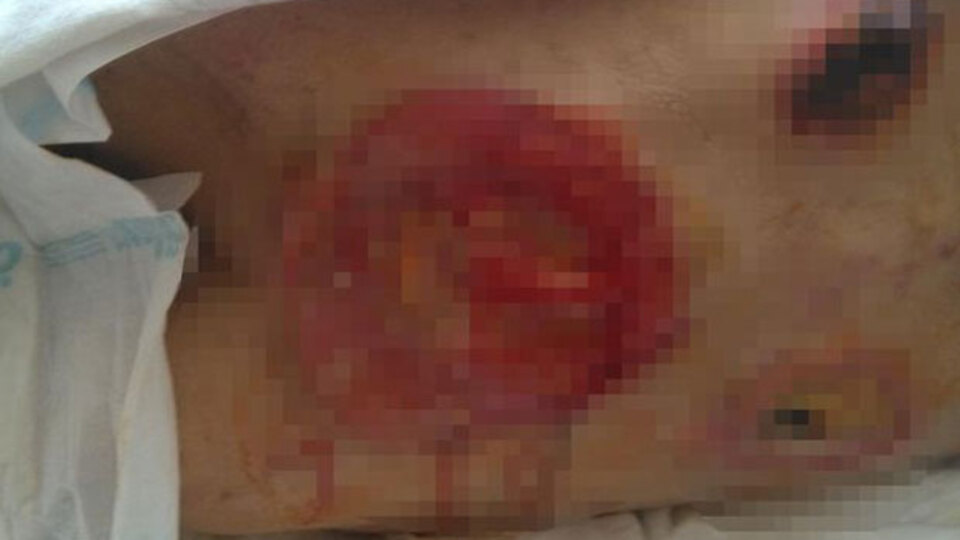 Korkunç! Hastanede 66 günde sırtı bu hale geldi