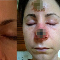 O ilaçtan sonra burnu çürümeye başladı!