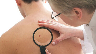 Cilt kanserinde devrim!