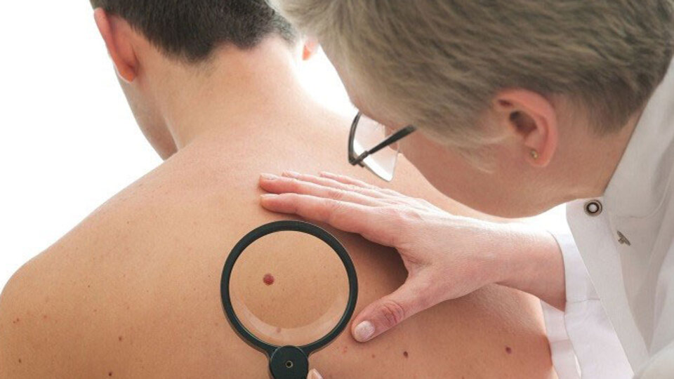 Cilt kanserinde devrim!