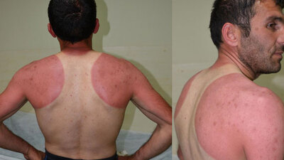 4 günlük raporu "yevmiyem kesilir" diye kabul etmedi!