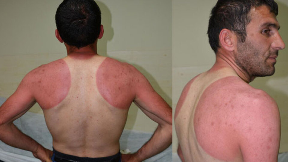 4 günlük raporu "yevmiyem kesilir" diye kabul etmedi!