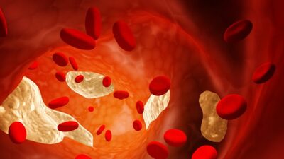 Kolesterol kalp hastalığına yol açar mı?