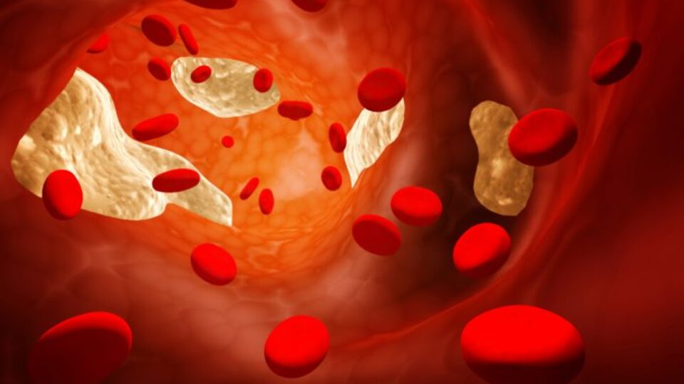 Kolesterol kalp hastalığına yol açar mı?