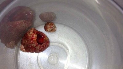 Şişlik ve şiddetli ağrı ağrının ardından bakın ne çıktı...