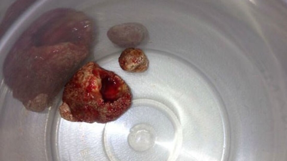 Şişlik ve şiddetli ağrı ağrının ardından bakın ne çıktı...