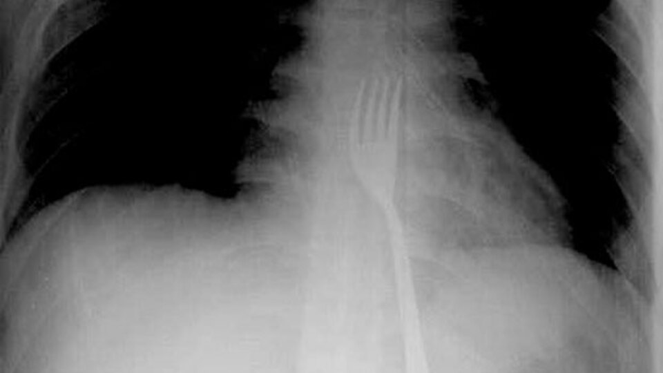 Şaşkına çeviren olay! 15 santimetrelik çatalı yuttu!