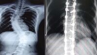 Baktığınızda omurganız düz görünmüyorsa...