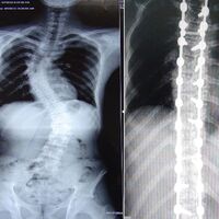 Baktığınızda omurganız düz görünmüyorsa...