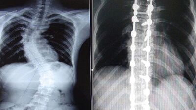 Baktığınızda omurganız düz görünmüyorsa...