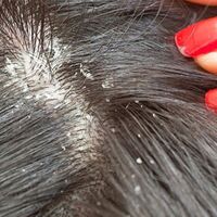 Kepek sebebiniz bu olabilir!