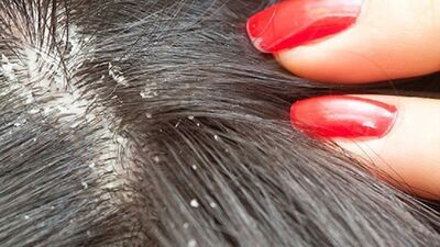 Kepek sebebiniz bu olabilir!