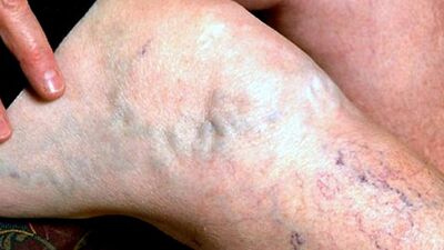 Sıcak hava varis şikayetini artırıyor