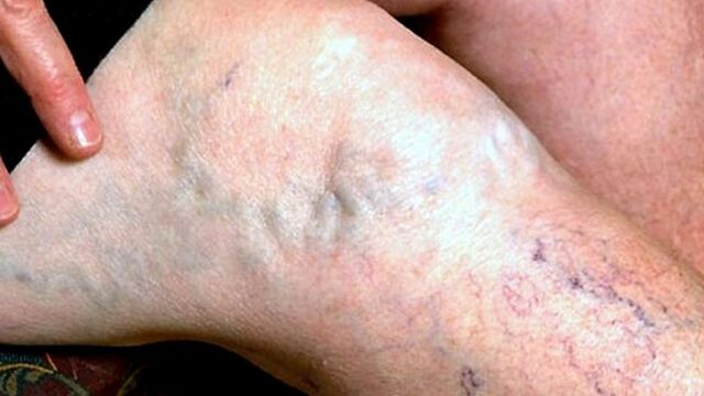 Sıcak hava varis şikayetini artırıyor