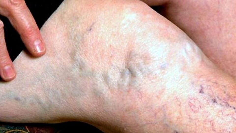 Sıcak hava varis şikayetini artırıyor