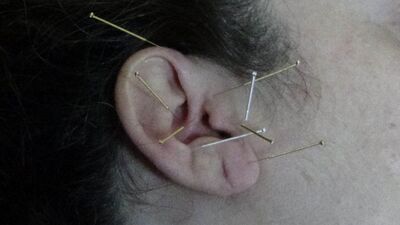 Depresyon ve bağımlılık tedavisine doğal destek: Akupunktur
