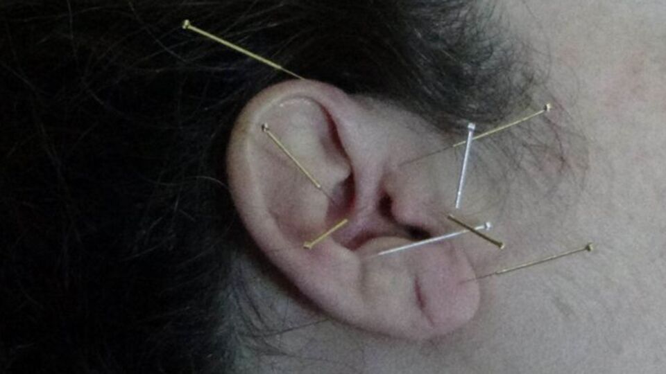 Depresyon ve bağımlılık tedavisine doğal destek: Akupunktur