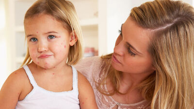 İşte çocukları tehdit eden yaz hastalıkları!