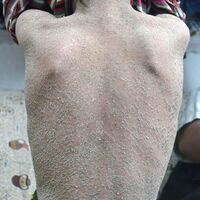 Tedavisi olmayan hastalıklar arasında...