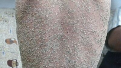 Tedavisi olmayan hastalıklar arasında...