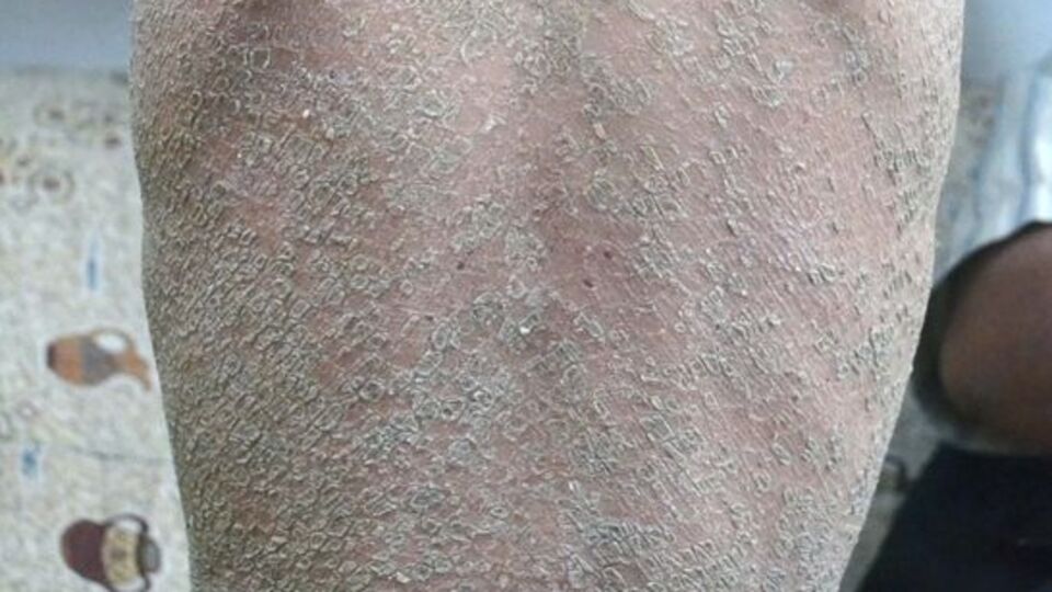 Tedavisi olmayan hastalıklar arasında...