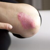 Sedef hastasının elini bile sıkmıyorlar...