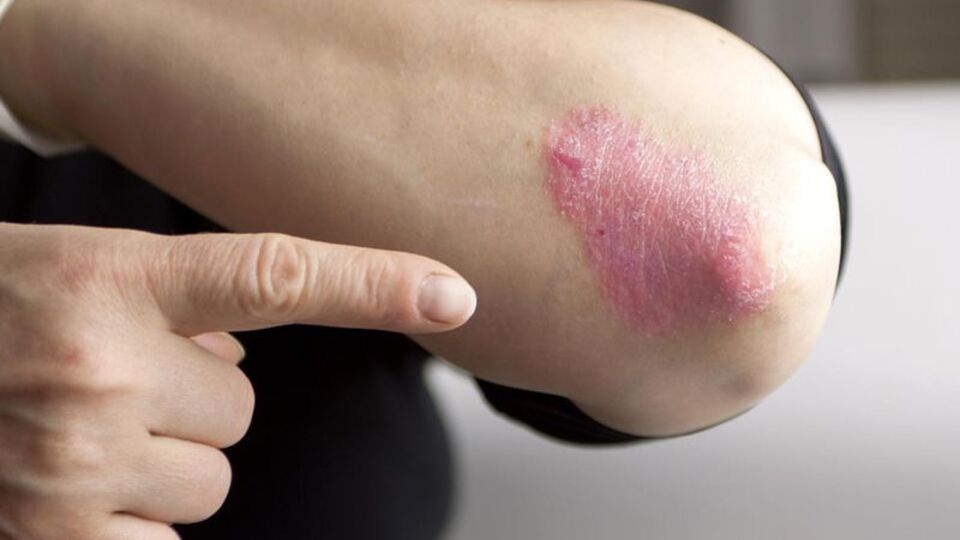 Sedef hastasının elini bile sıkmıyorlar...