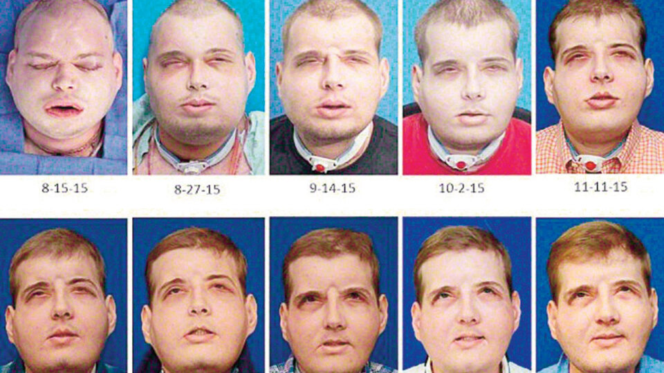 İşte dünyanın en kapsamlı yüz ameliyatı!