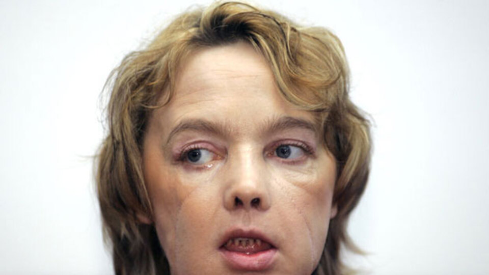 İlk kısmi yüz nakli yapılan kadının ölümünde sır perdesi!