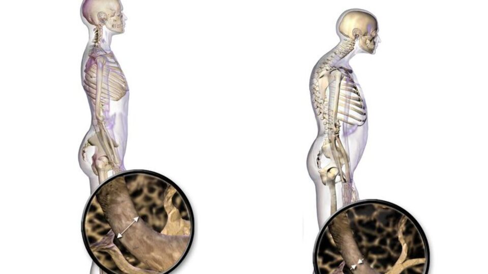 10 soruda osteoporoz riskinizi öğrenin!