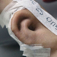 Kazada parçalanan kulağını kolunda büyüttüler!