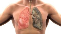 İşte akciğer kanserinin belirtileri!