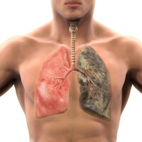 İşte akciğer kanserinin belirtileri!