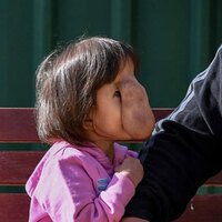 Suratındaki et parçası yüzünden evden çıkarmadılar! Ama...