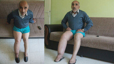 Böcek ısırığı sandı ama o hastalık hayatını kararttı!