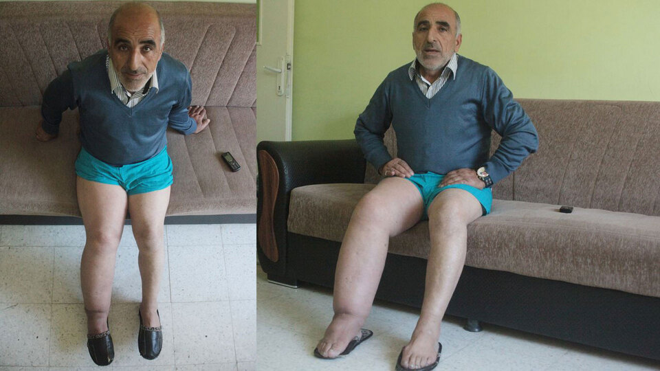 Böcek ısırığı sandı ama o hastalık hayatını kararttı!