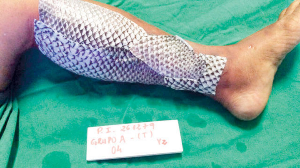 Vücuduna balık derileri sardı! 11 gün boyunca...