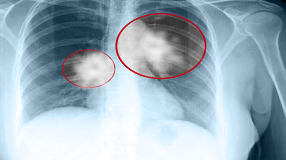 Göçmenlerde verem sıklığı giderek artıyor