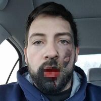 Elektronik sigara patladı! Hem dişleri döküldü hem de...