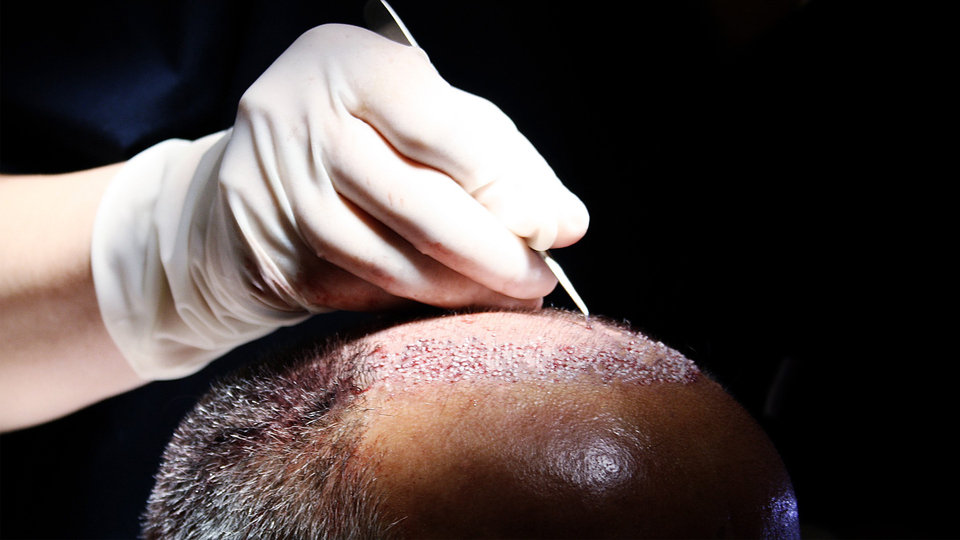 DEAŞ'lı teröristin 'saç ektirme' yalanı