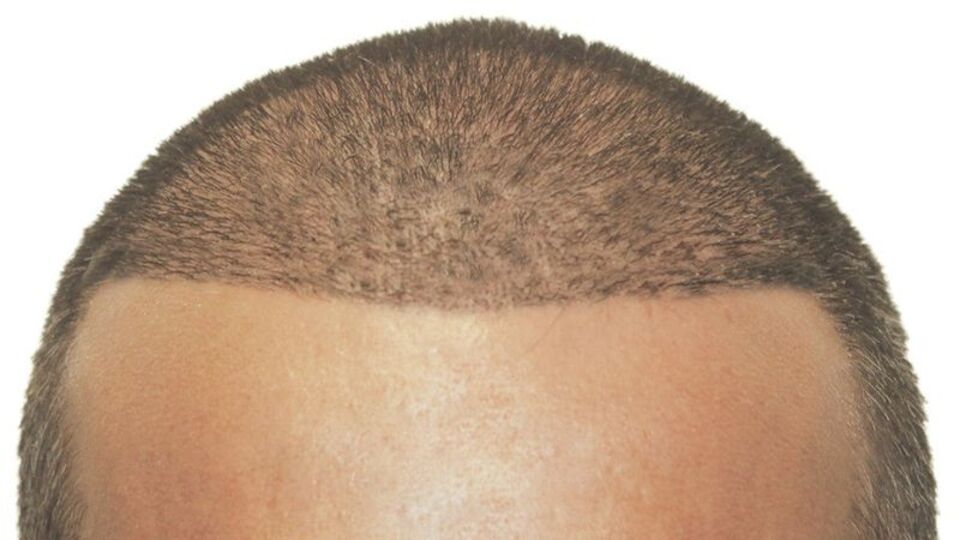 "Türkiye'de saç ekim merkezlerinin yüzde 50'den fazlası merdiven altı"