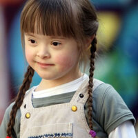 Down sendromunun belirtileri!