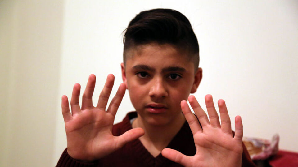 6 parmaklı doğdu! Bakın bu durumu nasıl fırsata çevirdi...