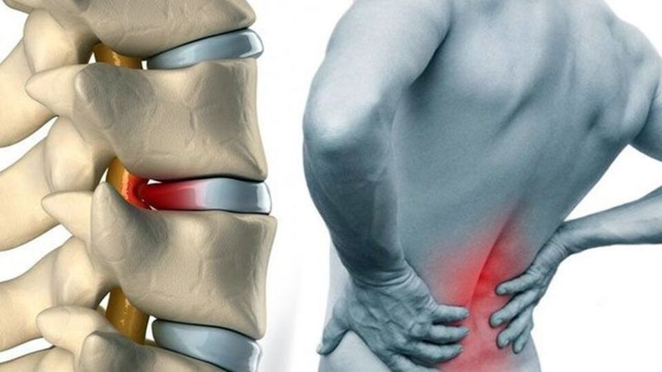 İşte bel fıtığının nedeni...